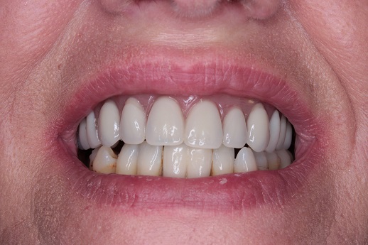 after dental implants